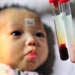 Anemia se presenta frecuentemente en el primer año de vida de un niño